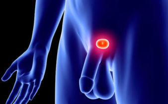 La Clinique Drevon propose un nouveau traitement des cancers localisés de la prostate.