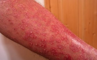 Tout ce que vous devez savoir sur l'eczéma / la dermatite.