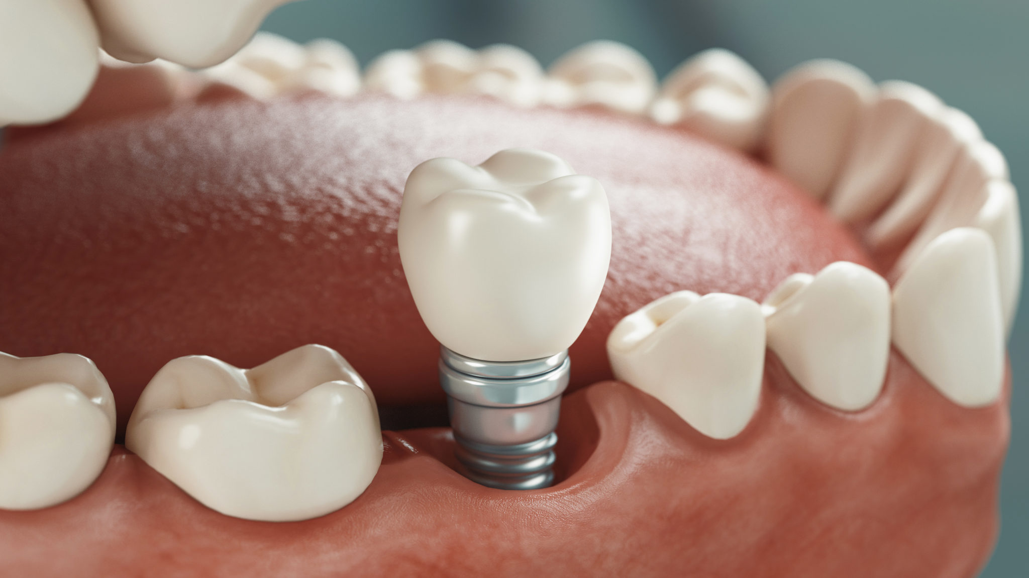 Lhygiène Des Implants Dentaires Est Elle Importante 