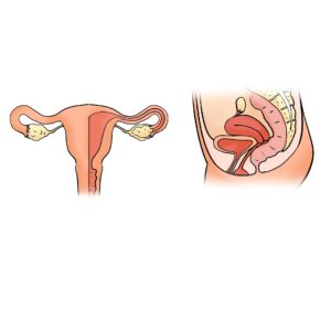 Syndrome des ovaires polykystiques : symptômes et traitements. 