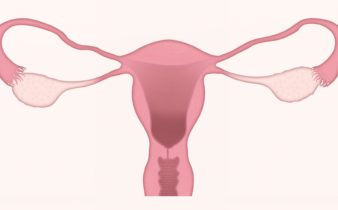 Syndrome des ovaires polykystiques : symptômes et traitements.