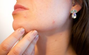 Comment se débarrasser naturellement des boutons sur le visage ?  