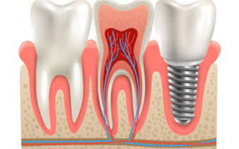 Implant dentaire : le guide complet pour faire le bon choix.