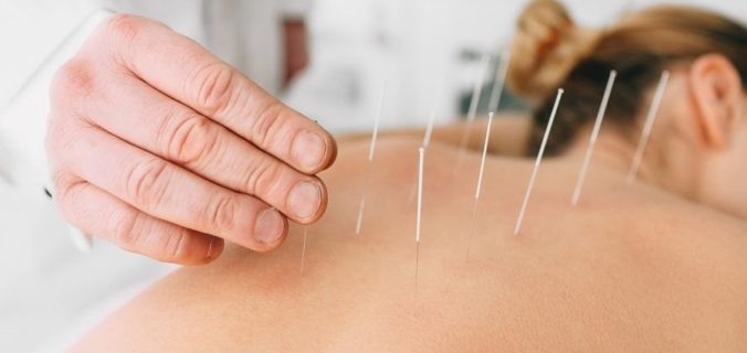 L’acuponcture peut-elle aider contre la perte de cheveux ?