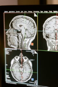 Maladie de Parkinson : tout savoir sur cette maladie neurodégénérative. 