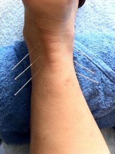 Comment acupuncture peut aider votre corps ?