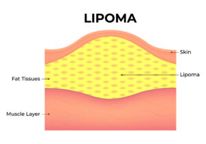 Lipomes : causes, symptômes et options de traitement.