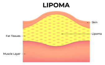 Lipomes : causes, symptômes et options de traitement.