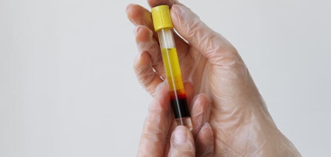 PRP : efficacité et indications en pathologies musculosquelettiques